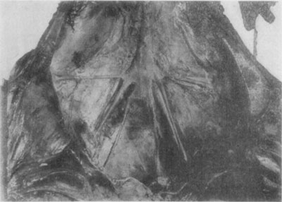 Fig. 49—Illustrative of thrombosis of the aorta, iliacs and branches. Photo by Dr. L.A. Merillat.