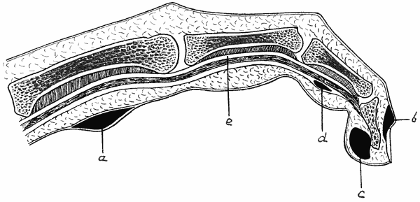 Fig. 9.—Diagram of various forms of Whitlow. a = Purulent blister. b = Suppuration at nail fold. c = Subcutaneous whitlow. d = Whitlow in sheath of flexor tendon (e).