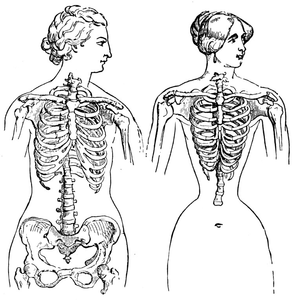 Anterior view of thorax in the Venus of Medicis. The same in a fashionable corset-wearing lady of to-day.