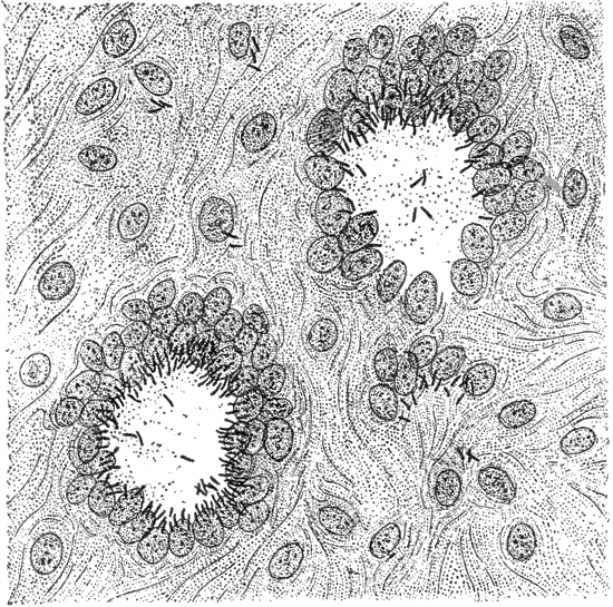 Tuberculous knot in the lungs