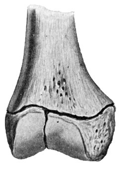 Fig. 11.—Complete Separation with Fracture of Epiphysis.