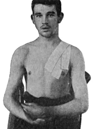 Fig. 15.—Adhesive Plaster applied for Fracture of Clavicle.