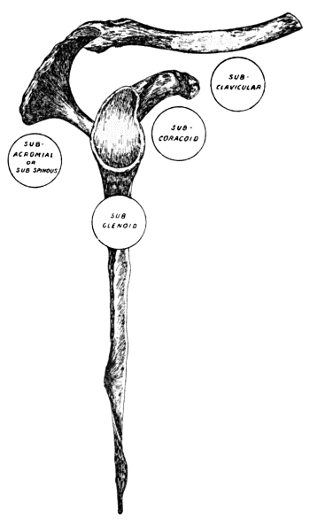 Fig. 17.—Diagram of most common varieties of Dislocation of the Shoulder.