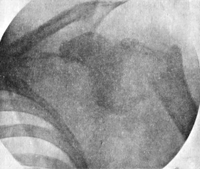 Fig. 25.—Dislocation of Shoulder with Fracture of Neck of Humerus.