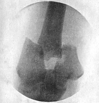 Fig. 34.—Radiogram of T-shaped Fracture of Lower End of Humerus.