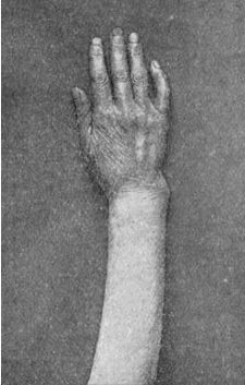 Fig. 44.—Colles' Fracture showing undue prominence of ulnar styloid.