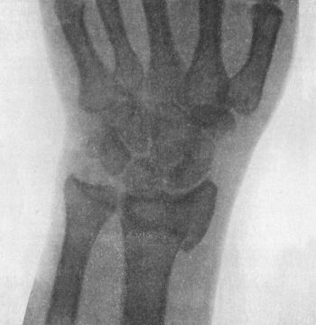 Fig. 45.—Radiogram showing the line of fracture and upward displacement of the radial styloid in Colles' Fracture.