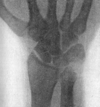 Fig. 49.—Radiogram showing Fracture of Navicular (Scaphoid) Bone.