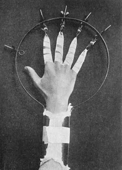 Fig. 52.—Extension apparatus for Oblique Fracture of Metacarpals.