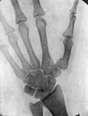 Fig. 53.—Radiogram of Bennett's Fracture of Base of Metacarpal of Right Thumb.