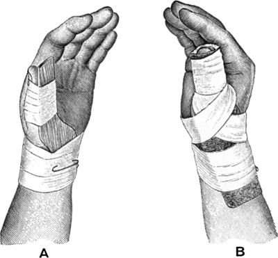 Fig. 54.—A. Splint applied as used by Bennett. B. Poroplastic Moulded Splint for Bennett's Fracture.