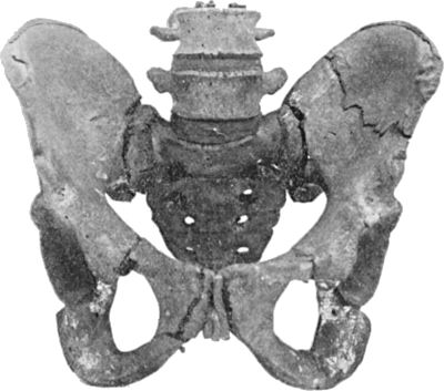 Fig. 56.—Fracture of left Iliac Bone; and of both Pubic Arches.