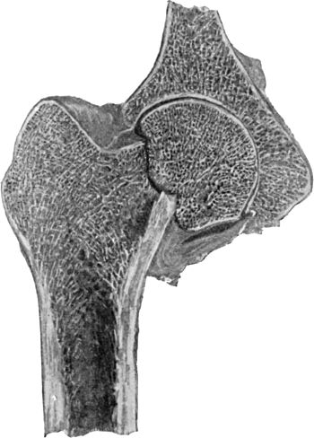 Fig. 62.—Impacted Fracture through Narrow Part of Neck of Femur.