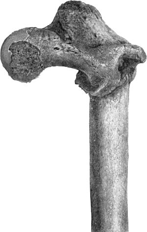 Fig. 69.—Fracture of the Femur just below the Small Trochanter united, showing flexion and lateral rotation of upper fragment.