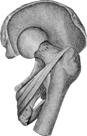 Fig. 73.—Dislocation on to Dorsum Ilii. Note relation of neck of femur to tendons of obturator internus and gemelli (diagrammatic).