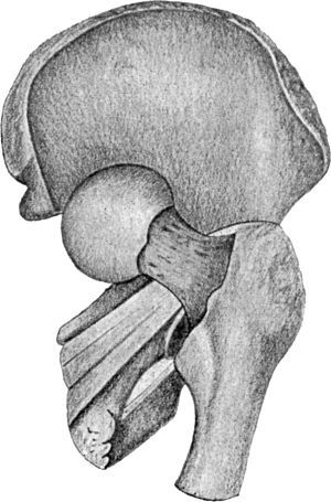 Fig. 74.—Dislocation into the vicinity of the Ischiatic Notch. Note relation of neck of femur to tendons of obturator and gemelli, “Dislocation below the tendon” (diagrammatic).