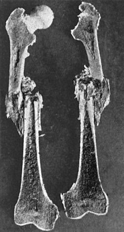 Fig. 75.—Longitudinal section of Femur showing recent Fracture of Shaft with overriding of Fragments.