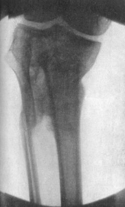 Fig. 84.—Radiogram of Fracture of Head of Tibia and Upper Third of Fibula.