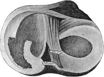 Fig. 86.—Diagram of Longitudinal Tear of Posterior End of Right Medial Semilunar Meniscus.