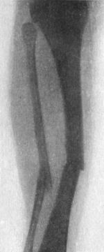 Fig. 89.—Radiogram of Transverse Fracture of both Bones of Leg by direct violence.