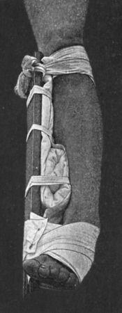 Fig. 96.—Dupuytren's Splint applied to correct eversion of foot.