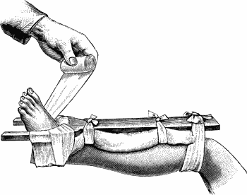 Fig. 97.—Syme's Horse-shoe Splint applied to correct backward displacement of foot.