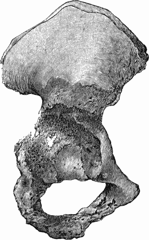 Fig. 108.—Advanced Tuberculous Disease of Acetabulum with caries and perforation into pelvis.