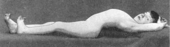 Fig. 112.—Disease of Left Hip: exaggeration of lordosis produced by extending the limb.