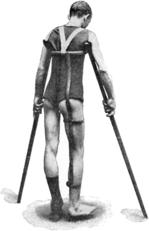 Fig. 118.—Thomas' Hip Splint applied for disease of Right Hip. Note patten under sound foot. The foot on the affected side is too near the ground.