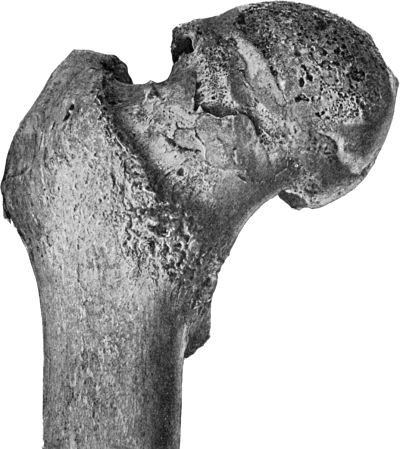 Fig. 119.—Arthritis Deformans, showing erosion of cartilage and lipping of articular edge of head of femur.