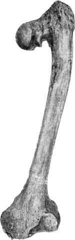 Fig. 121.—Femur in advanced Arthritis Deformans of Hip and Knee Joints. The upper end of the bone shows the condition of coxa vara; the lower end shows enlargement of the medial condyle and alteration in the axis of the articular surface.