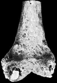 Fig. 123.—Lower End of Femur from an advanced case of Tuberculous Arthritis of the Knee. Towards the posterior aspect of the medial condyle there is a wedge-shaped sequestrum, of which the surface exposed to the joint is polished like porcelain.