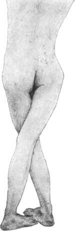 Fig. 134.—Bilateral Coxa Vara, showing scissors-leg deformity.