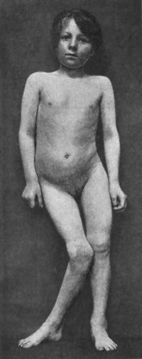 Fig. 136.—Female child with right-sided Genu Valgum, the result of Rickets. The pelvis is tilted, and the spine is curved.