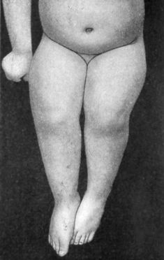 Fig. 140.—Genu Valgum. Same patient as Fig. 139. Sitting, to show disappearance of deformity on flexion of knee.