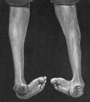 Fig. 144.—Congenital Talipes Equino-varus in a man æt. 24; seen from behind.