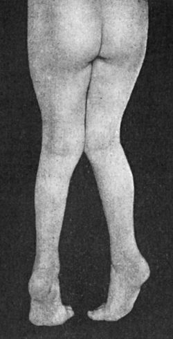 Fig. 145.—Bilateral Pes Equinus in a boy æt. 7, the result of Spastic Paralysis.