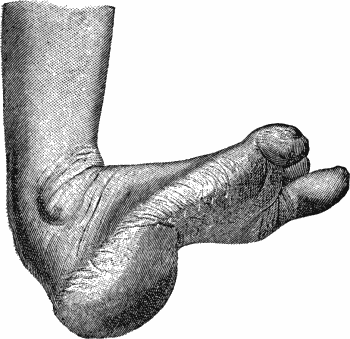 Fig. 148.—Pes Calcaneo-valgus with excessive arching of foot.