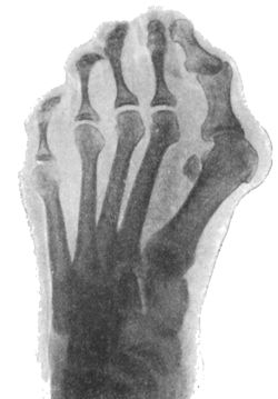 Fig. 157.—Radiogram of Hallux Valgus. The sesamoid bone is seen displaced towards middle line of the foot.