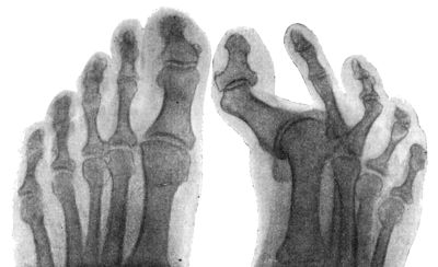 Fig. 158.—Radiogram of Hallux Varus or Pigeon-toe.