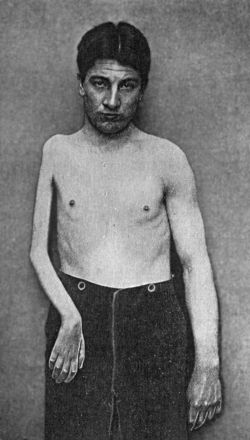 Fig. 166.—Arrested Growth and Wasting of Tissues of Right Upper Extremity, the result of Anterior Poliomyelitis in childhood.