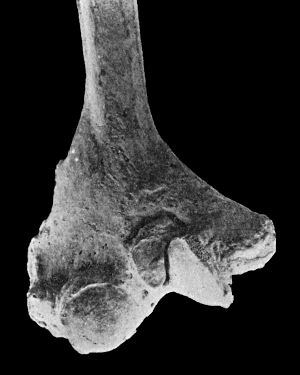 Fig. 167.—Lower end of Humerus from case of Cubitus Varus.