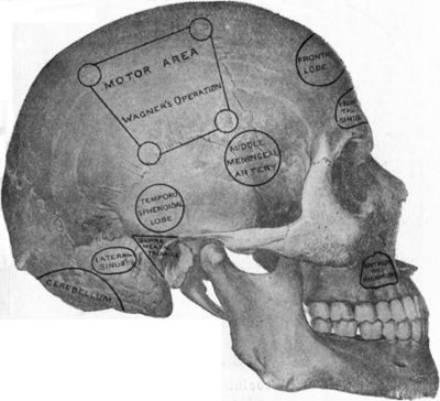 Fig. 182.—To illustrate the site of various operations on the skull.