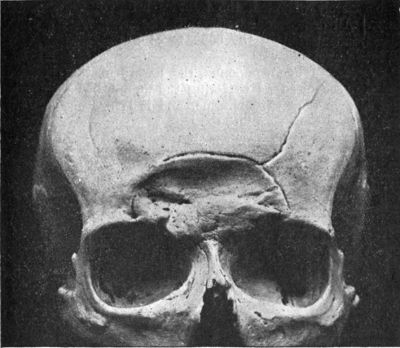 Fig. 188.—Depressed Fracture of Frontal Bones—involving the air sinus on both sides—with a fissured fracture radiating from it.