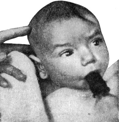 Fig. 190.—Pond Fracture of Left Frontal Bone, produced during delivery.