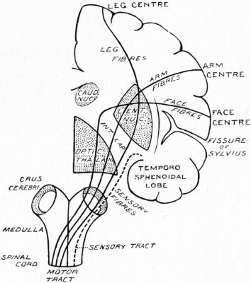 Fig. 195.—Diagram illustrating Sequence of Paralysis, caused by abscess in temporal lobe. (After Macewen.)