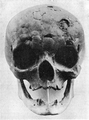 Fig. 202.—Skull of woman illustrating the appearances of Tertiary Syphilis of Frontal Bone—Corona Veneris—in the healed condition.