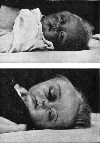 Fig. 203.—Sarcoma of Orbital Plate of Frontal Bone in a child at age of 11 months, and 18 months.