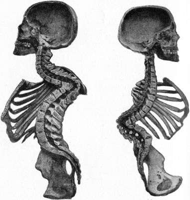 Fig. 211.—Osseous Ankylosis of Bodies (a) of Dorsal Vertebræ, (b) of Lumbar Vertebræ following Pott's disease. There is marked kyphosis at the seat of the disease and compensatory lordosis above and below.