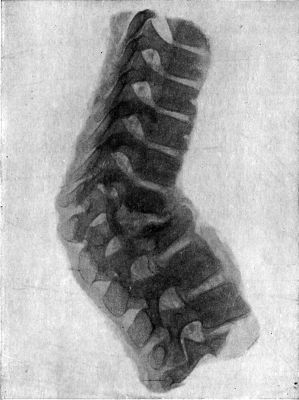 Fig. 212.—Radiogram of Museum Specimen of Pott's disease in a Child; the disease is located at the thoracico-lumbar junction.